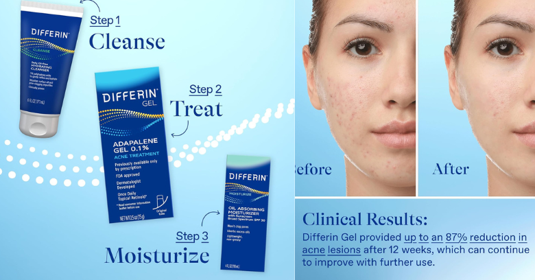 Differin Acne Treatment Gel: Guide for Blemish-Free Skin