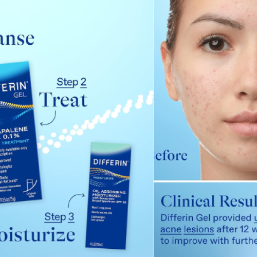 Differin Acne Treatment Gel: Guide for Blemish-Free Skin